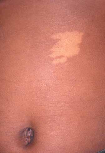 The surface of the nevus may become nodular; the hair that can arise is usually coarse. Giant congenital nevi are defined as larger than 20 cm.