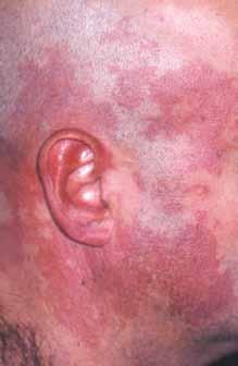 The absence of erythema is attributed to blood vessel constriction that is secondary to increased blood vessel sensitivity to catecholamines.