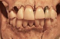 Teeth that fit together properly, last longer PCS: Problem,