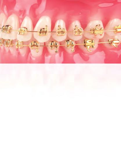 The real 24 carat gold is applied via a patented process and is guaranteed against wear or discoloration.