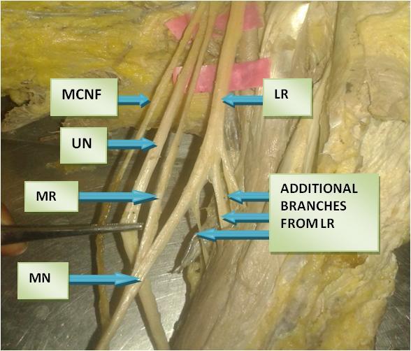 This additional medial (Branches of third part of axillary artery) and profunda root joined the median nerve in the midarm region. In brachii artery (Branch of brachial artery).