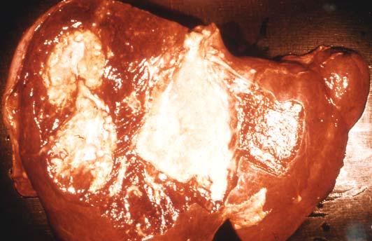 Multiple abscesses in liver from a fatal case