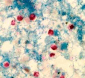 Oocysts of Cryptosporidium parvum Clinical Disease: Secretory diarrhea. In HIV(+) patients, this infection was often fatal.