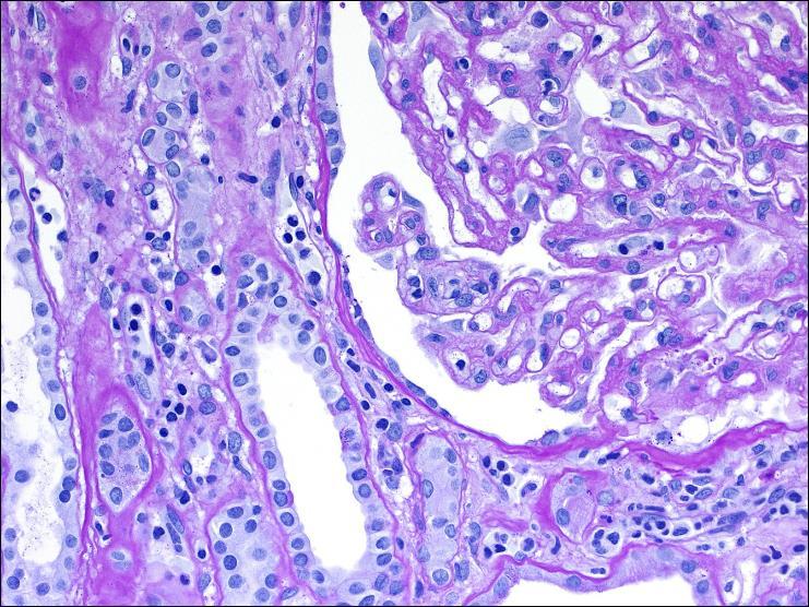 Asterisk segmental sclerosis; methenamine silver stain, 400x. Insert (b) shows glomerular double contours along the entire capillary circumference (arrowheads).