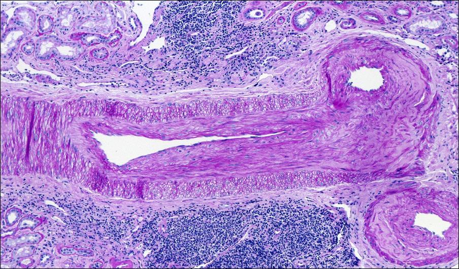 15 Figure 4. Severe arterial luminal narrowing due to new onset intimal fibrosis. (periodic acid-schiff stain, 200x).