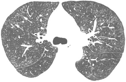 Respiratory bronchiolitis-ild