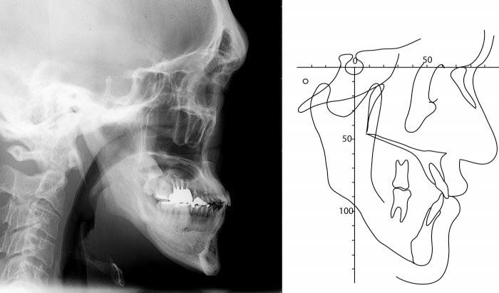 128 YAGI, KAWAKAMI, TAKADA FIGURE 6. (A) Lateral cephalometric radiograph and (B) its tracing after active treatment. FIGURE 7. Intraoral photographs after active treatment.