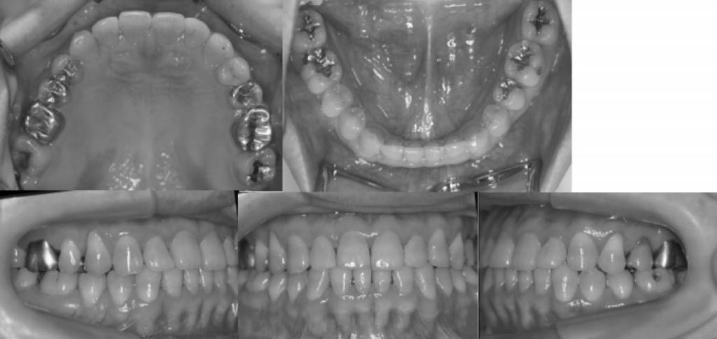 3 It is accepted that after the reestablishment of endocrine balance, mandibular osteotomies should be considered to reestablish the premorbid facial contours and occlusion.