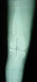 OA after mal union of femoral shaft fracture Post osteotomy and TKR Computer