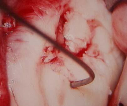 Articular Cartilage Lesions Articular cartilage