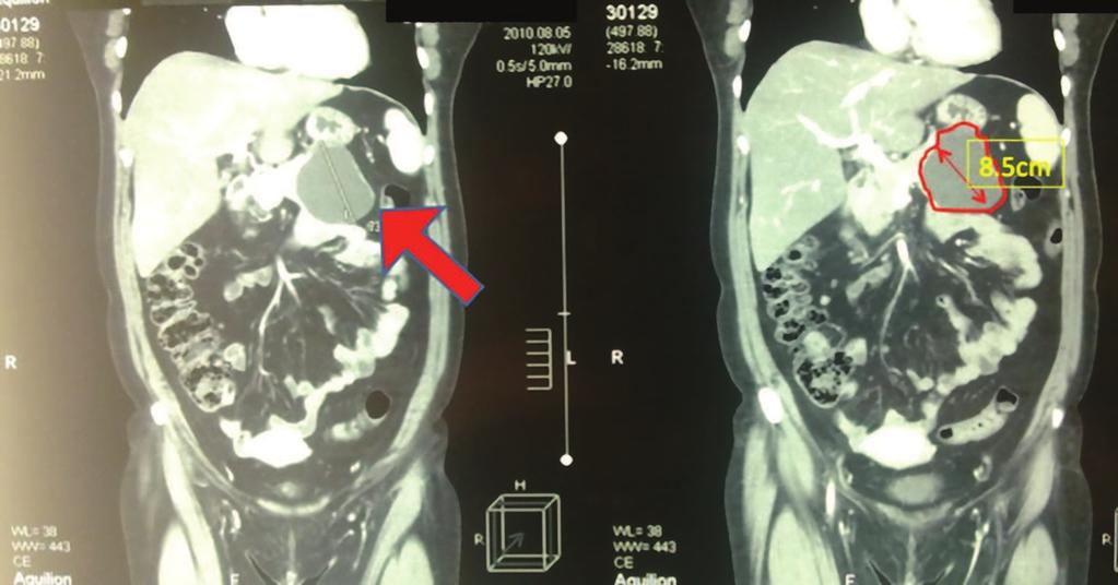 Management of Pancreatic Cystic Lesions http://dx.doi.org/10.5772/65117 109 The multislice CT shows cystic mass located in the tail of the pancreas, size.