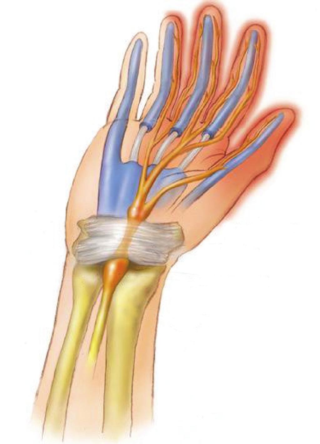 Carpal tunnel syndrome Patient Information Clinical Support