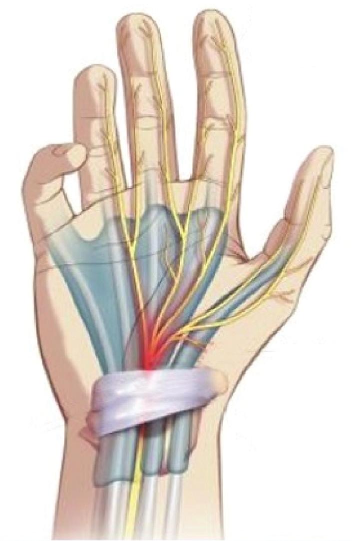 What is carpal tunnel syndrome? Carpal tunnel syndrome is a condition in which the median nerve is squeezed or pinched where it passes through the wrist. The reason for this is usually unknown.