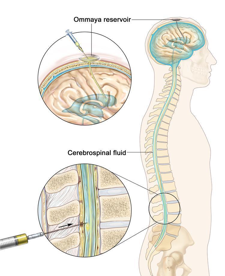 Intrathecal Chemotherapy Injected into the subarachnoid space Reaches the CNS Used to treat leukemia and lymphoma that has spread to the