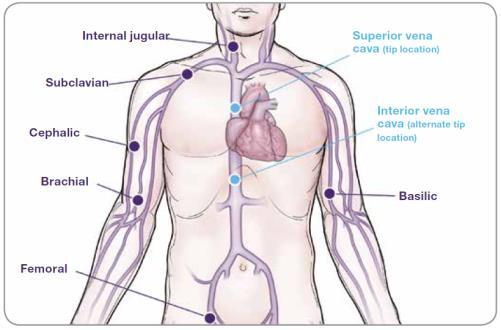 Central (CVAD) Central (CVAD) Contraindications Thrombosis of subclavian,