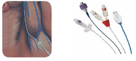 Midline Catheters Indications Therapies expected to last 1-4 weeks May be used for therapies