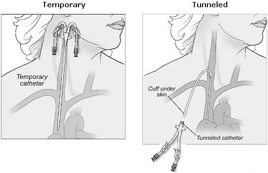 Catheter placement Temporary should not accept in outpatient clinics- not tunneled. Looks like Frankenstein.