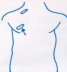 INSERTION OF CATHETER (3) two small incisions upper chest near the neck by isolating the vein chosen for