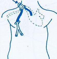 INSERTION OF CATHETER (7) Trim and flush the catheter Insert the