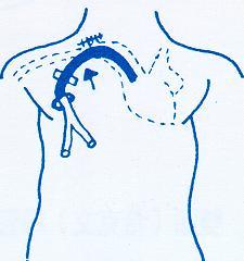 INSERTION OF CATHETER (8) Continue advance the catheter under flouroscopy to the junction of the