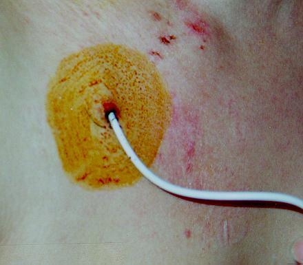 CATHETER SITE CARE (6) Dressing changes: Clean the skin from the exit site