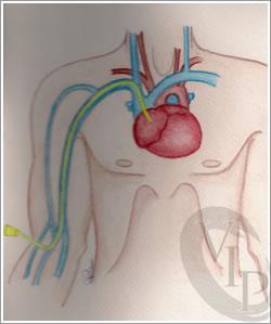 The venous catheter is inserted with the tip in the superior vena