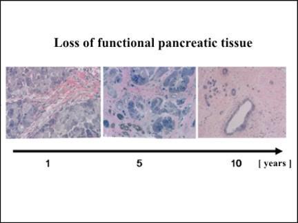 Fig. 4 Time depend histological changes in chronic pancreatitis Creatorrhoea (excess nitrogen losses in the stool: >2.