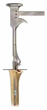 11 Comprehensive Fracture System Surgical Technique Figure 16b Figure 16a Figure 17 Humeral Stem Insertion In order to allow for a 2 3 mm cement mantle, select a trial stem 2 3 mm smaller than the