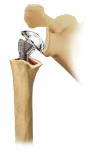 Normally, the humeral component should travel only 25 to 50% of the length of the glenoid with inferior traction. If more than that is possible, the prosthesis is seated too low.