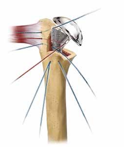 14 Comprehensive Fracture System Surgical Technique Figure 21 Figure 22 Tuberosity Reattachment This is the most critical part of the procedure. There are many acceptable variations.
