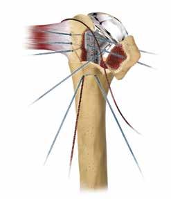 ) Pass the longitudinal suture, previously placed through the lateral hole in the humeral shaft, inside