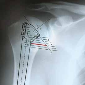 Find a bony landmark along the fracture line that can be used as a reference and draw a line on the X-ray at that exact point. In many instances, the medial calcar can be used (Figure 1).