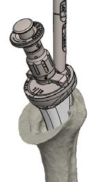 the manufacturer s instructions. Extrude the bone cement into the humeral canal, distal to proximal, using a retrograde technique.