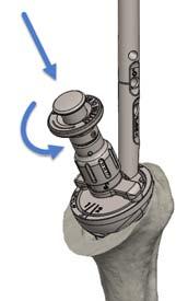 the instrument handle. Upon completion, remove the instrument handle and any remaining excess bone cement.
