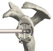 6.2 Definition of glenoid centre, baseplate and glenosphere size Connect the Glenoid Multi-purpose Handle to the Reverse Glenoid Aiming Device.