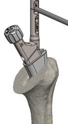 it to its inserter by rotating the knob clockwise and insert it into the humeral canal until the marked