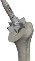 Use the retroversion rod to check the Trial Humeral Diaphysis insertion alignment with respect to the