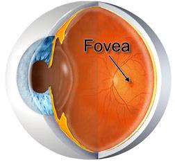 MACULA ON vs OFF ON fovea is attached - good initial vision 20/30-2/50 better
