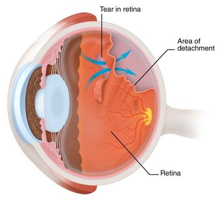 RHEGMATOGENOUS RD tear bleeding into vitreous fluids enters and dissects