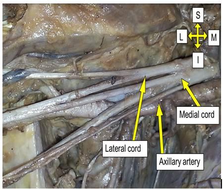 Fig. 1: Axillary artery lying posterior to medial and lateral cords of brachial plexus.