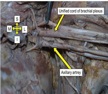 3: Variation in realtionship of axillary artery lying posteromedial to the unified cord of brachial plexus.