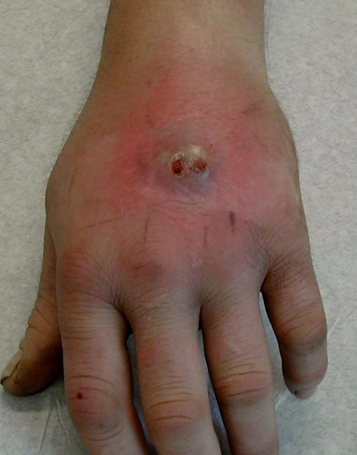 Case History: Skin & Soft Tissue A 28-year-old man presents with an abscess on his hand and fever (T = 38.6 C).