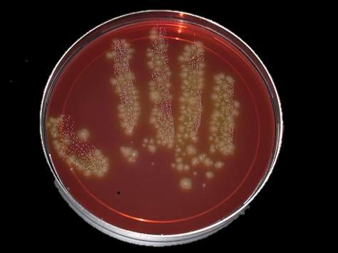 Clostridium difficile Associated Diarrhea Diagnostic Tests Stool culture for C.