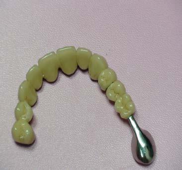 there to offer to such patients? Solving this problem is quite possible. We can offer the so called denture, Bridge of Bruklin.