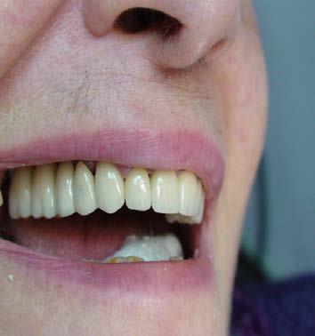 It is a great relief for the patients who have been suffering from using partial removable dentures for years. It is a great opportunity for them to start a new life.