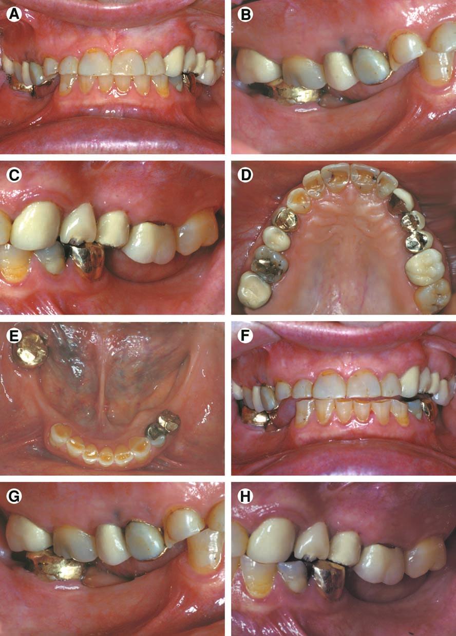Figure 4. Class IV patient. Edentulous areas are found in both arches, and the physiologic abutment support is compromised.