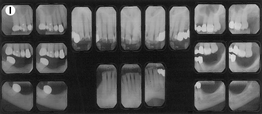 September 2002, Volume 11, Number 3 191 Figure 4. (Cont d) (I) Full mouth radiographic series.