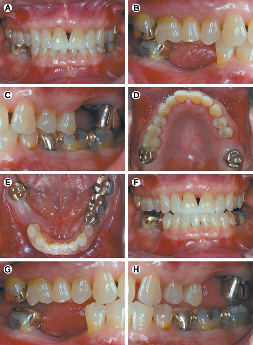 186 Classification System for Partial Edentulism McGarry et al Figure 2. Class II patient. This patient is Class II because he has edentulous areas in 2 sextants in different arches.