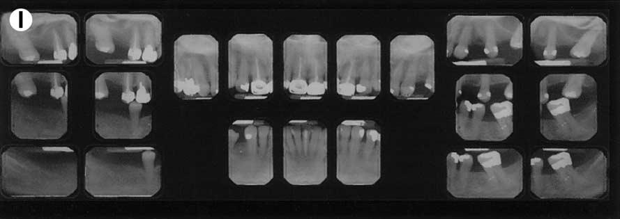 September 2002, Volume 11, Number 3 189 Figure 3. (Cont d) (I) Full mouth radiographic series. The edentulous areas do not compromise the physiologic support of the abutments.