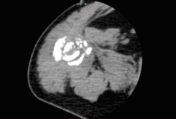 Vaidya et al. 197 CASE REPORT A 55-year-old male initially presented with pain and difficulty in moving his right arm after a fall. No significant past medical or family history was noted.